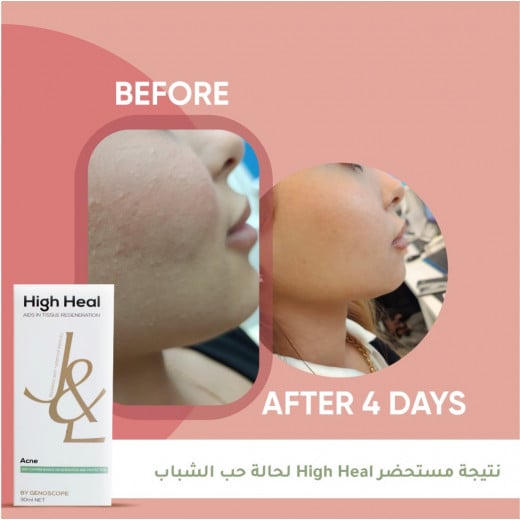 HIGH HEAL FOR ACNE